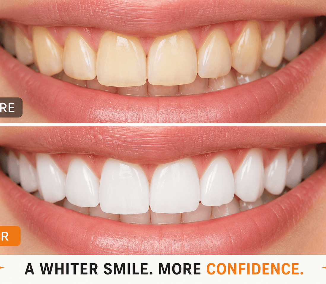 Teeth Whitening